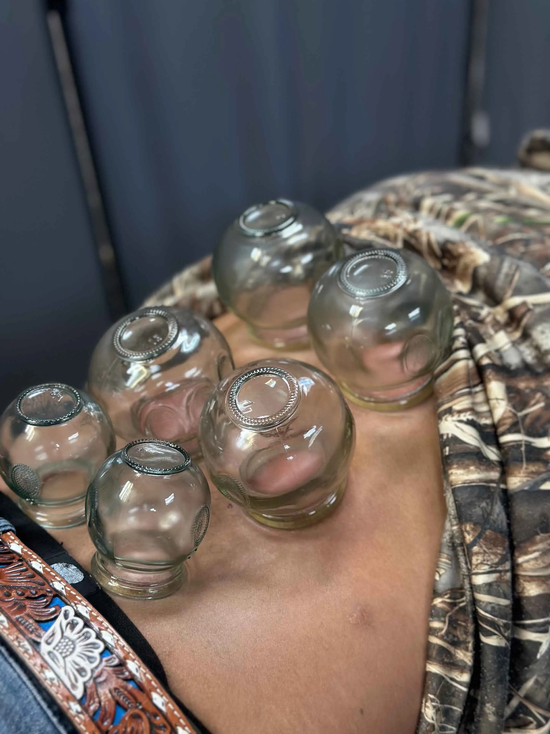 Fire Cupping at Back 2 Health Chiropractic